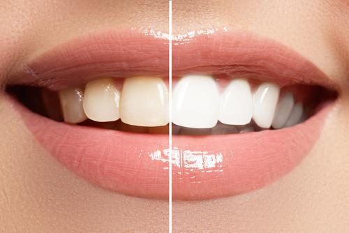 Diamond Tier Teeth Whitening Service